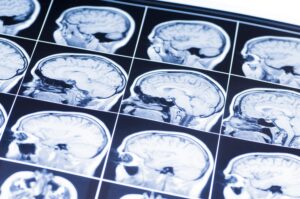 Anesthesia Errors and Brain Injuries: Legal Recourse for Patients